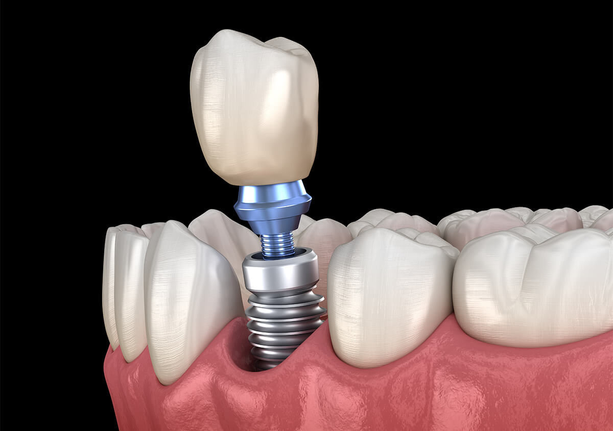 Tooth Implant Surgery in Kalispell MT Area