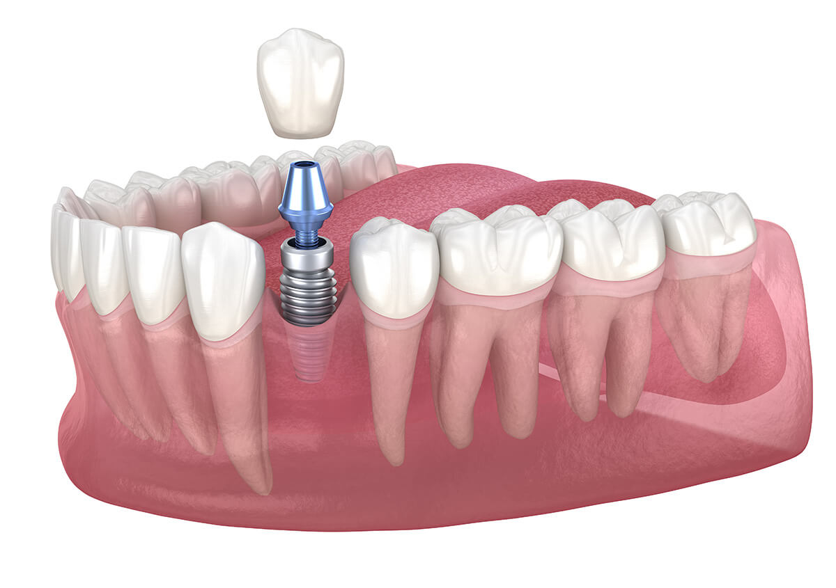 Are Dental Implants Permanent in Kalispell MT Area
